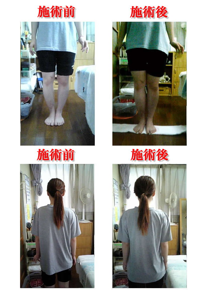 O脚矯正